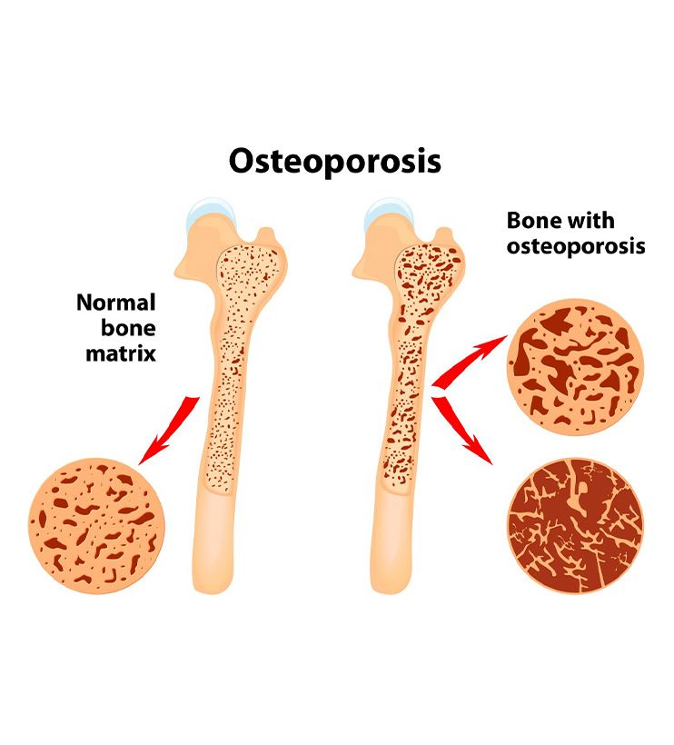 Burbank Osteoporosis Specialists | Orthopaedic Surgery Specialists